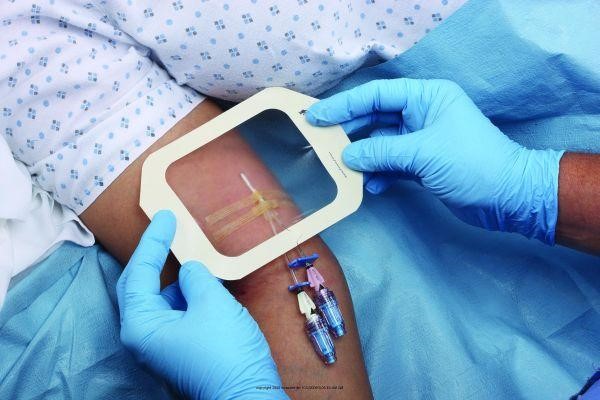 Transparent Film Bandage over Catheter