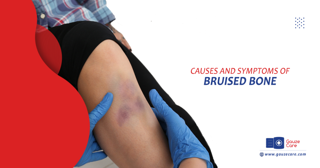 Causes and Symptoms of Bruised Bone